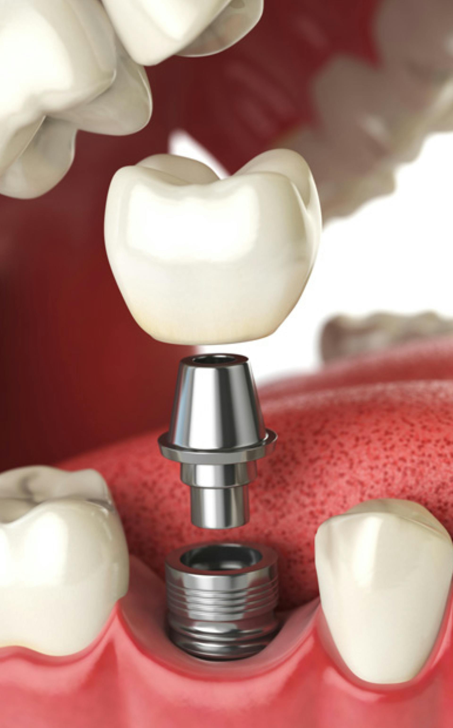L'implantologie dentaire